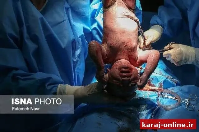 افزایش سزارین و کاهش زایمان طبیعی در البرز